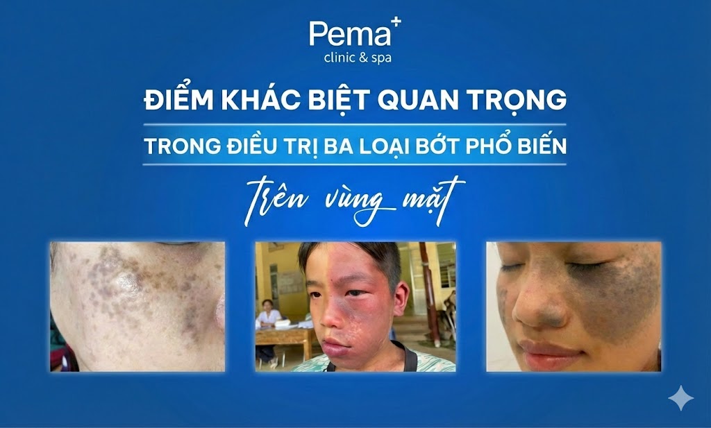 Khác biệt trong điều trị 3 loại bớt phổ biến ở vùng mặt